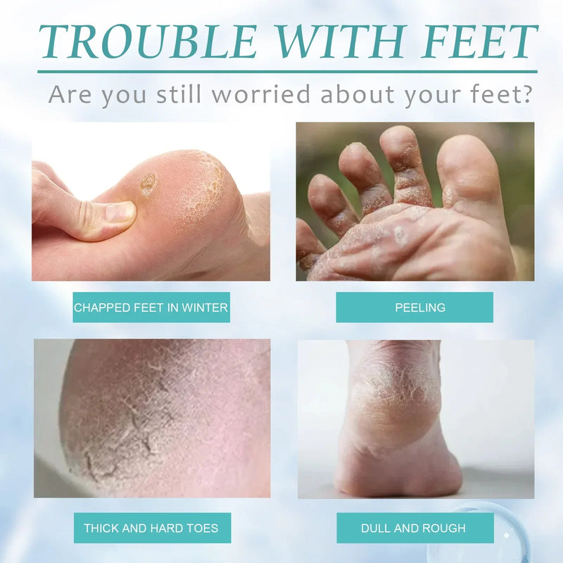 Calluses Remover Foot Spray Peeling Dead Skin Exfoliator Anti Drying Crack Heels Smoothing Soften Repair Whiten Foot Care Liquid