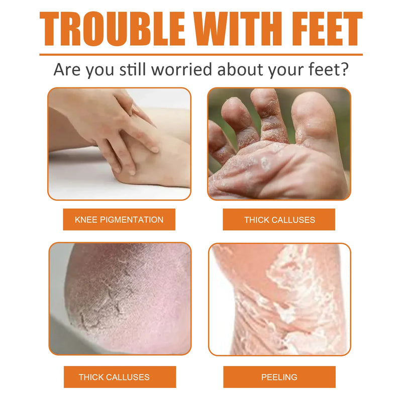 Calluses Remover Foot Spray Anti-Drying Exfoliating Heel Cracked Repair Pedicure Hand Elbow Eliminate Dead Skin Foot Liquid 30ml