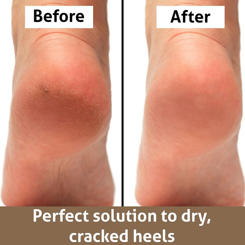 Foot File Rasp Callus Removal Blade for Feet Heel Callus Shaver Cuticle Cutter and Corn Remover Pedis Tool Salon Pedicure Care